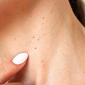 Wart Removal in Houston, TX