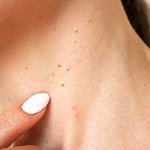 Wart Removal in Houston, TX